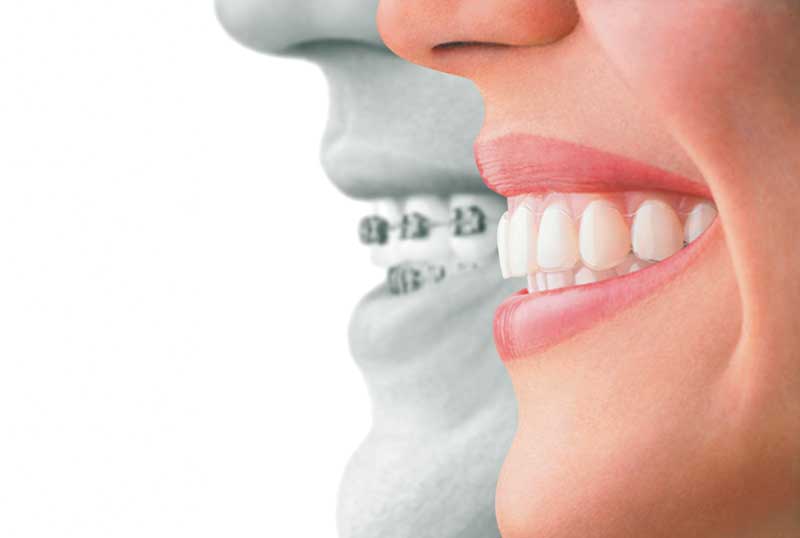 Invisalign & Braces in Hamilton | Red Rose Dentistry