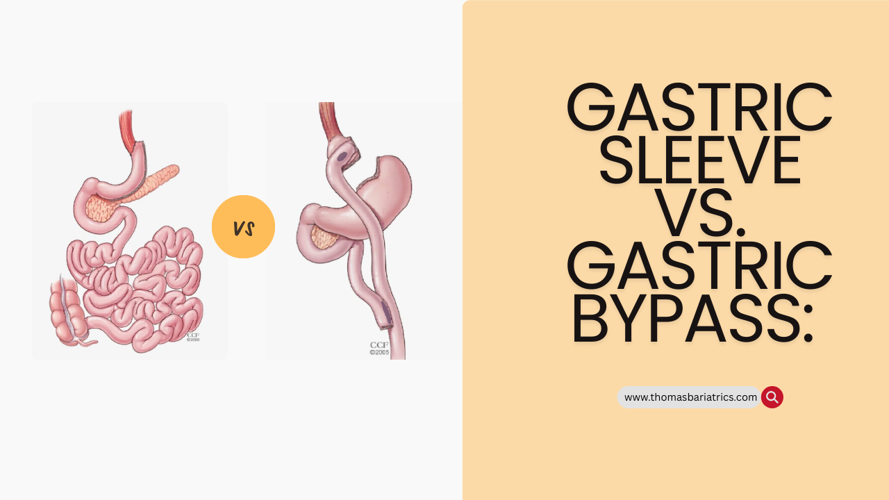 Gastric Sleeve vs. Gastric Bypass | thomasbariatrics