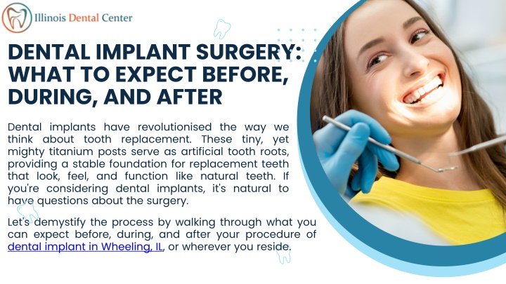 PPT - Dental Implant Surgery What to Expect Before, During, and After PowerPoint Presentation - ID:14205810