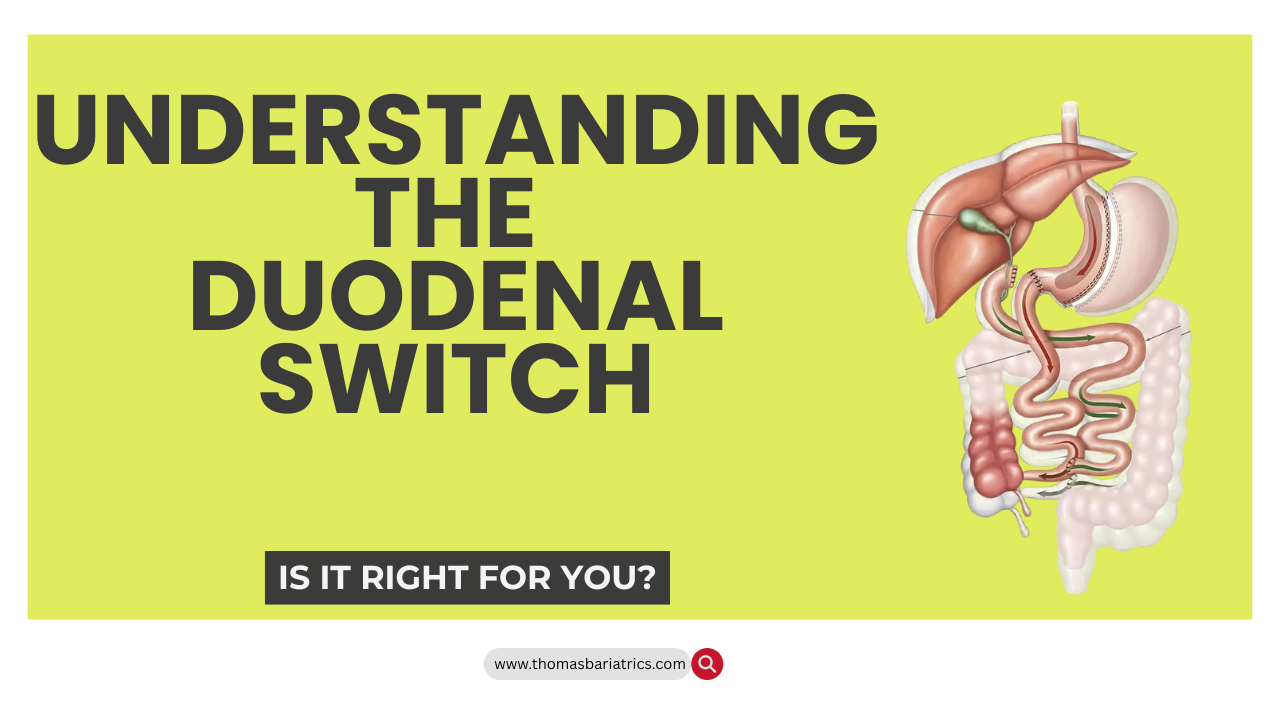 Understanding the Duodenal Switch | thomasbariatrics