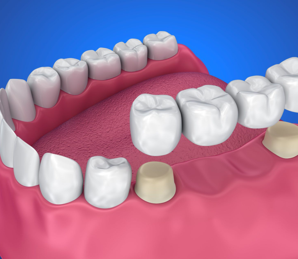 High-Quality Dental Crowns in Dubai | Restore Your Smile