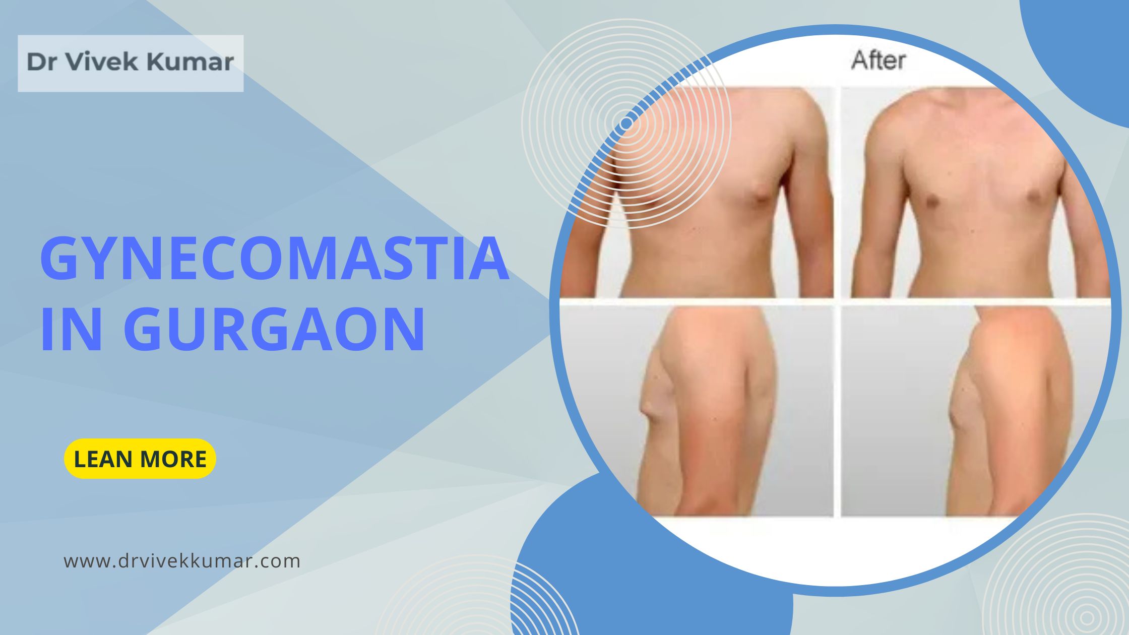 Gynecomastia in Gurgaon: Safe, Effective Male Breast Reduction Surgery - Jordan Sheel