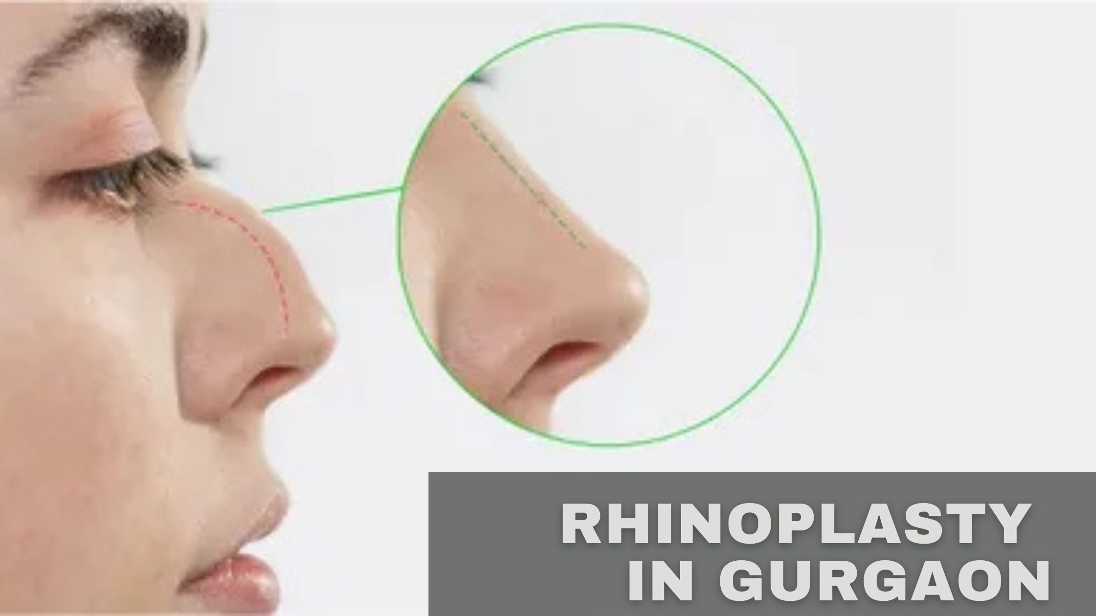 Rhinoplasty in Gurgaon: Redefine Your Facial Harmony with Precision Surgery - CurveCleaverus