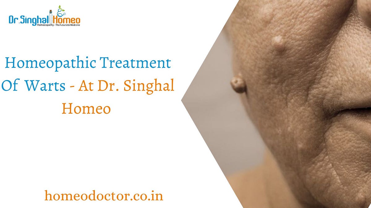 Discover the Power of Homeopathy: Your Guide to Effective Wart Treatment | by Dr. Singhal Homeo | Jul, 2025 | Medium