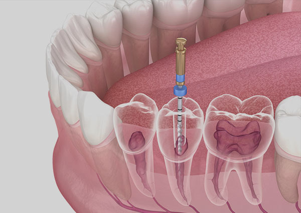 Root Canal Treatment in RR Nagar – Site Title