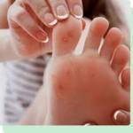 Cure For Warts On Feet Elizabeth