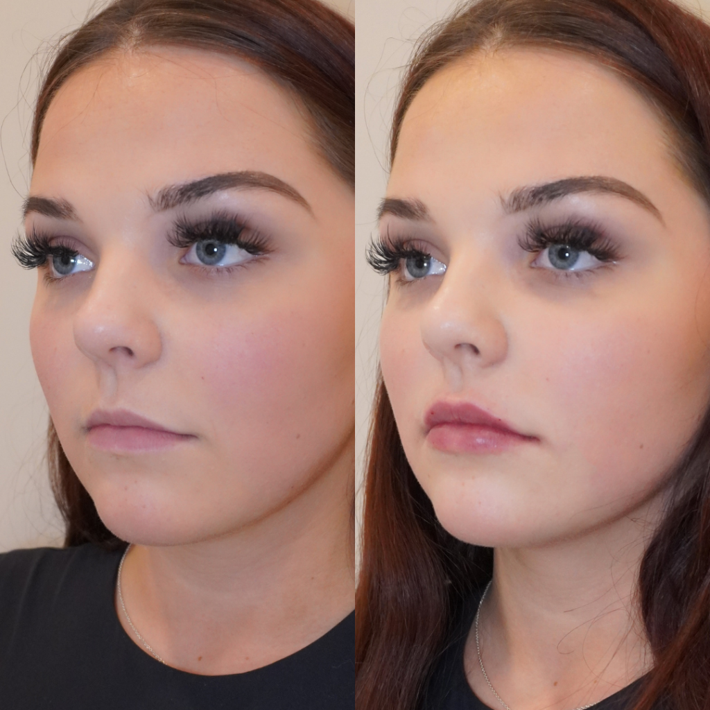 Guide to Botox Treatments in Mississauga - nebulawellness