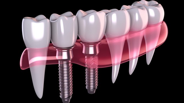 Restoring confidence through dental implants ~ Ace Dental Centre