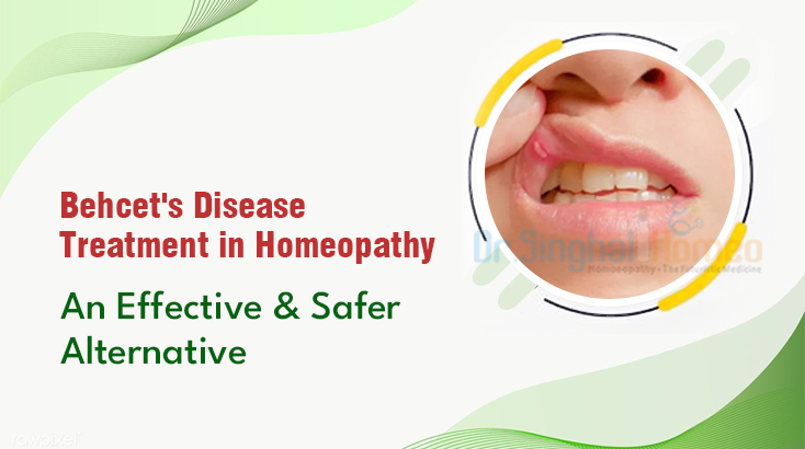 Finding Hope in Natural Healing: Homeopathic Treatment for Behcet’s Disease – health