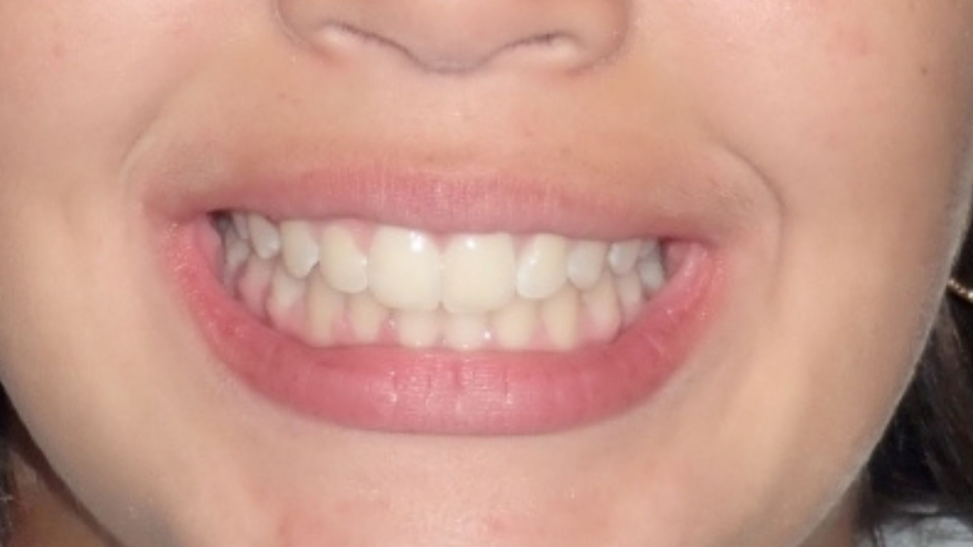 Braces in Pennsauken | Merchantville Invisalign | Cinnaminson | Cherry Hill Braces