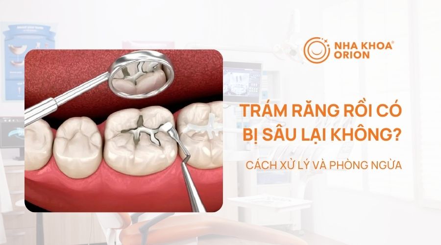 Trám răng rồi có bị sâu lại không? Cách xử lý và phòng ngừa