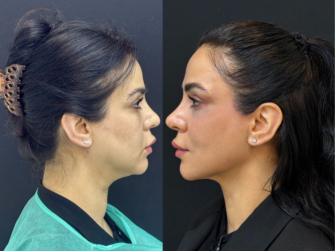 Endolift Laser Dubai | Blue Angel Poly Clinic