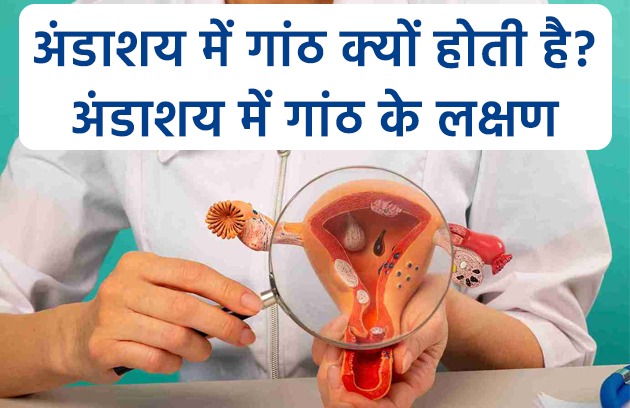 अंडाशय में गांठ क्यों होती है? जानें ओवेरियन सिस्ट का आयुर्वेदिक इलाज